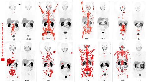 psma pet imaging